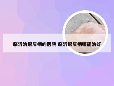 临沂治银屑病的医院 临沂银屑病哪能治好