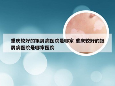 重庆较好的银屑病医院是哪家 重庆较好的银屑病医院是哪家医院