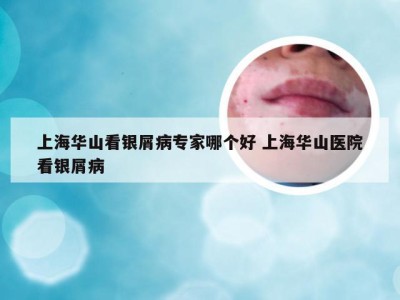 上海华山看银屑病专家哪个好 上海华山医院看银屑病