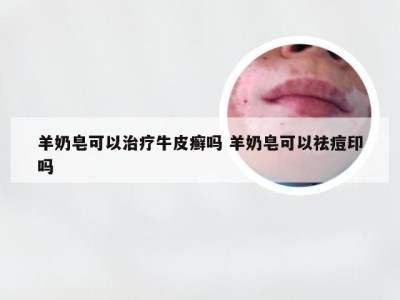 羊奶皂可以治疗牛皮癣吗 羊奶皂可以祛痘印吗
