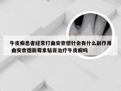 牛皮癣患者经常打曲安奈德针会有什么副作用 曲安奈德新霉素贴膏治疗牛皮癣吗