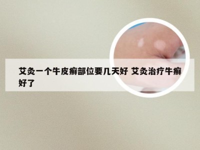 艾灸一个牛皮癣部位要几天好 艾灸治疗牛癣好了