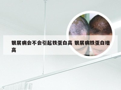 银屑病会不会引起铁蛋白高 银屑病铁蛋白增高