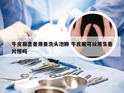 牛皮癣患者用姜洗头泡脚 牛皮廨可以用生姜片擦吗