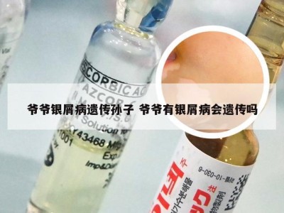 爷爷银屑病遗传孙子 爷爷有银屑病会遗传吗