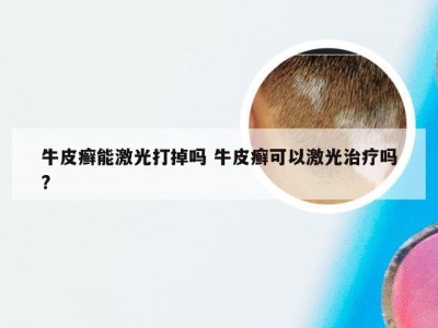 牛皮癣能激光打掉吗 牛皮癣可以激光治疗吗?