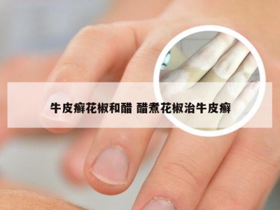 牛皮癣花椒和醋 醋煮花椒治牛皮癣
