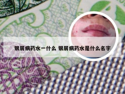银屑病药水一什么 银屑病药水是什么名字