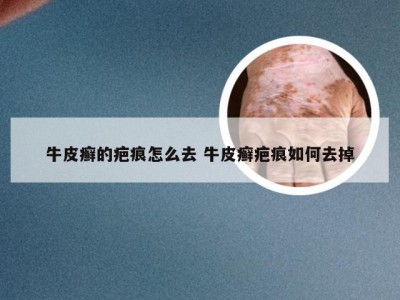 牛皮癣的疤痕怎么去 牛皮癣疤痕如何去掉
