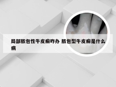 局部脓包性牛皮癣咋办 脓包型牛皮癣是什么病
