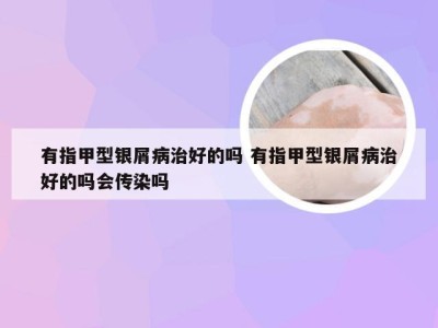 有指甲型银屑病治好的吗 有指甲型银屑病治好的吗会传染吗