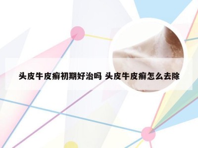 头皮牛皮癣初期好治吗 头皮牛皮癣怎么去除