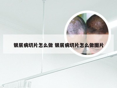 银屑病切片怎么做 银屑病切片怎么做图片