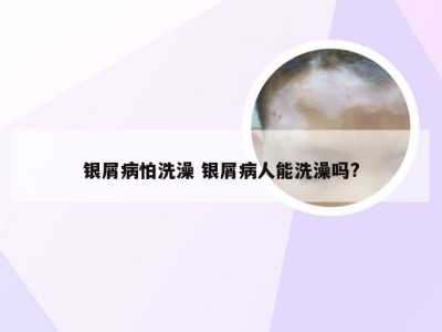 银屑病怕洗澡 银屑病人能洗澡吗?