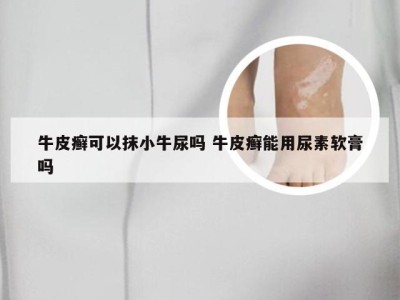 牛皮癣可以抹小牛尿吗 牛皮癣能用尿素软膏吗
