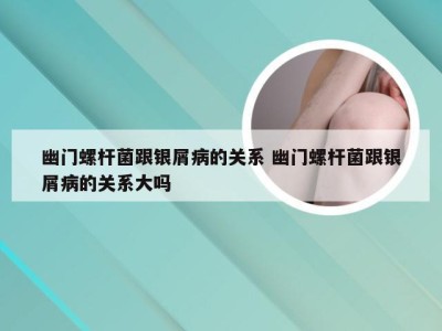 幽门螺杆菌跟银屑病的关系 幽门螺杆菌跟银屑病的关系大吗