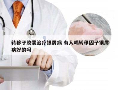 转移子胶囊治疗银屑病 有人喝转移因子银屑病好的吗