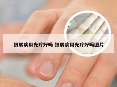 银屑病用光疗好吗 银屑病用光疗好吗图片