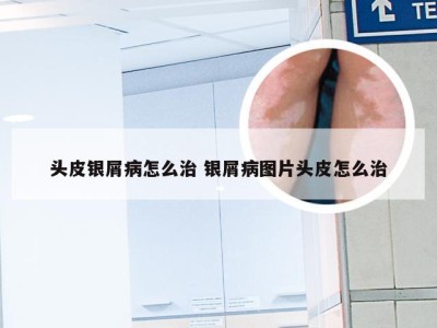 头皮银屑病怎么治 银屑病图片头皮怎么治