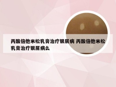 丙酸倍他米松乳膏治疗银屑病 丙酸倍他米松乳膏治疗银屑病么