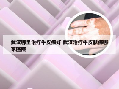 武汉哪里治疗牛皮癣好 武汉治疗牛皮肤癣哪家医院