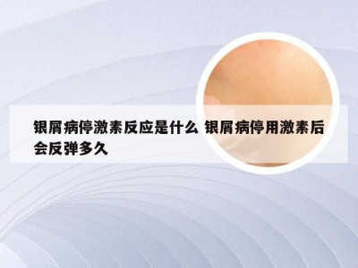 银屑病停激素反应是什么 银屑病停用激素后会反弹多久