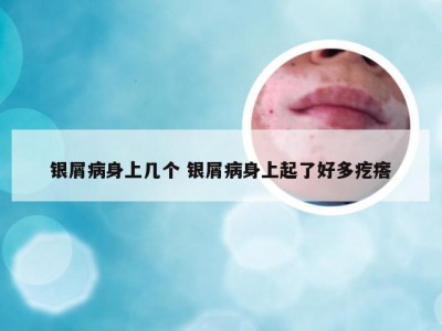 银屑病身上几个 银屑病身上起了好多疙瘩