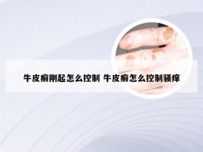 牛皮癣刚起怎么控制 牛皮癣怎么控制骚痒