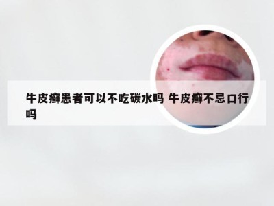 牛皮癣患者可以不吃碳水吗 牛皮癣不忌口行吗