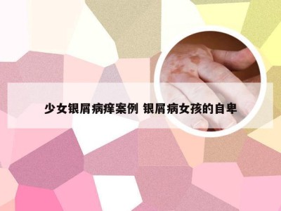 少女银屑病痒案例 银屑病女孩的自卑