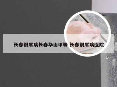 长春银屑病长春华山甲等 长春银屑病医院