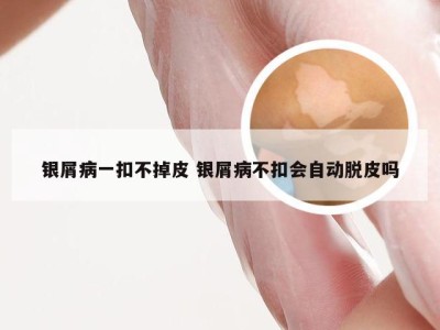 银屑病一扣不掉皮 银屑病不扣会自动脱皮吗