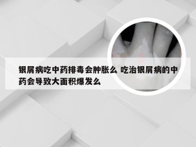 银屑病吃中药排毒会肿胀么 吃治银屑病的中药会导致大面积爆发么