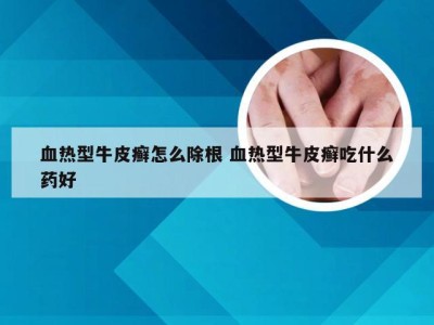 血热型牛皮癣怎么除根 血热型牛皮癣吃什么药好