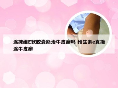 涂抹维E软胶囊能治牛皮癣吗 维生素e直接涂牛皮癣
