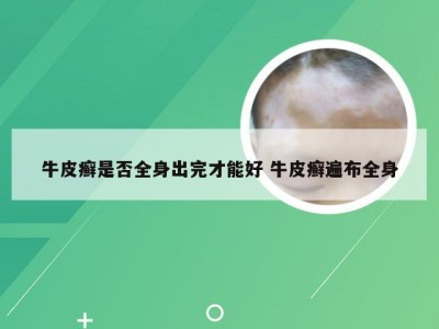 牛皮癣是否全身出完才能好 牛皮癣遍布全身