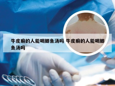 牛皮癣的人能喝鲫鱼汤吗 牛皮癣的人能喝鲫鱼汤吗