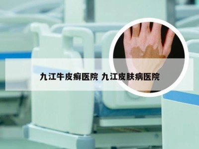 九江牛皮癣医院 九江皮肤病医院