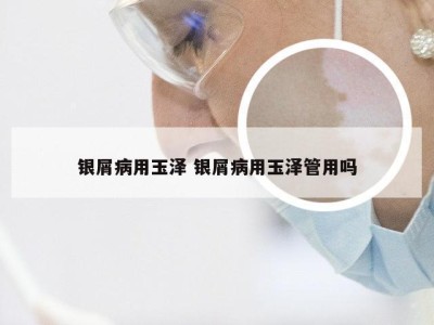 银屑病用玉泽 银屑病用玉泽管用吗