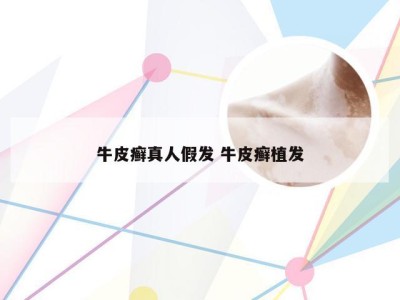 牛皮癣真人假发 牛皮癣植发