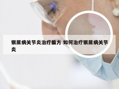 银屑病关节炎治疗偏方 如何治疗银屑病关节炎