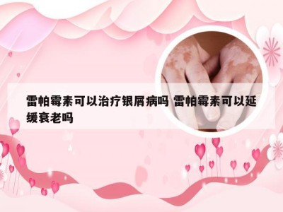 雷帕霉素可以治疗银屑病吗 雷帕霉素可以延缓衰老吗
