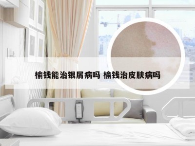 榆钱能治银屑病吗 榆钱治皮肤病吗
