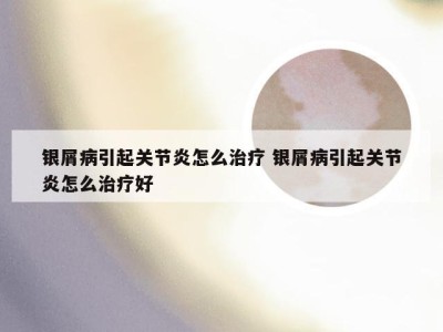 银屑病引起关节炎怎么治疗 银屑病引起关节炎怎么治疗好