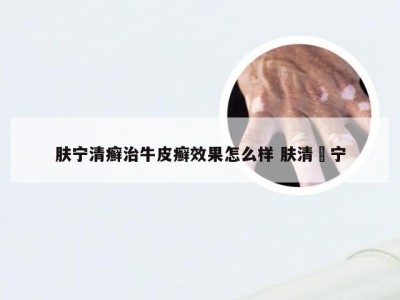 肤宁清癣治牛皮癣效果怎么样 肤清庎宁