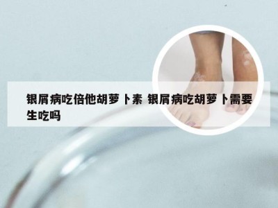 银屑病吃倍他胡萝卜素 银屑病吃胡萝卜需要生吃吗