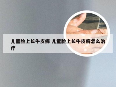 儿童脸上长牛皮癣 儿童脸上长牛皮癣怎么治疗