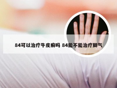 84可以治疗牛皮癣吗 84能不能治疗脚气