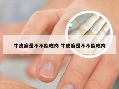 牛皮癣是不不能吃肉 牛皮癣是不不能吃肉