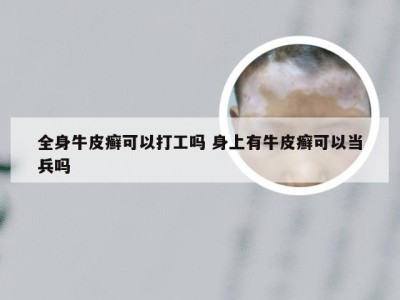 全身牛皮癣可以打工吗 身上有牛皮癣可以当兵吗